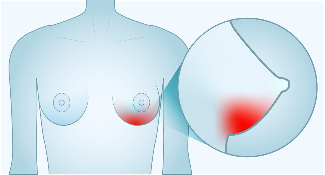 swelling, redness or other visible differences in one or both breasts